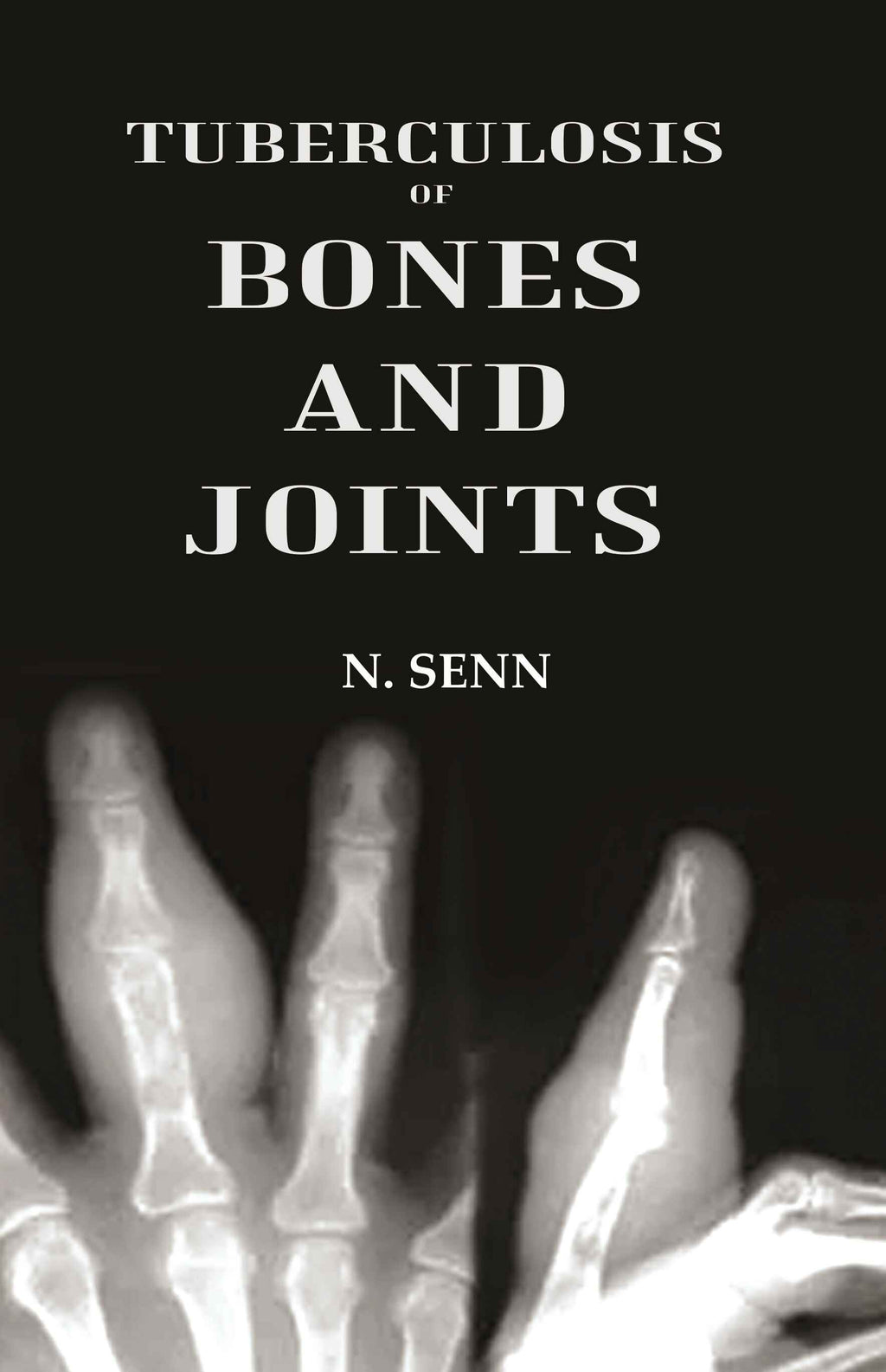 Tuberculosis of Bones and Joints - Gyan Books