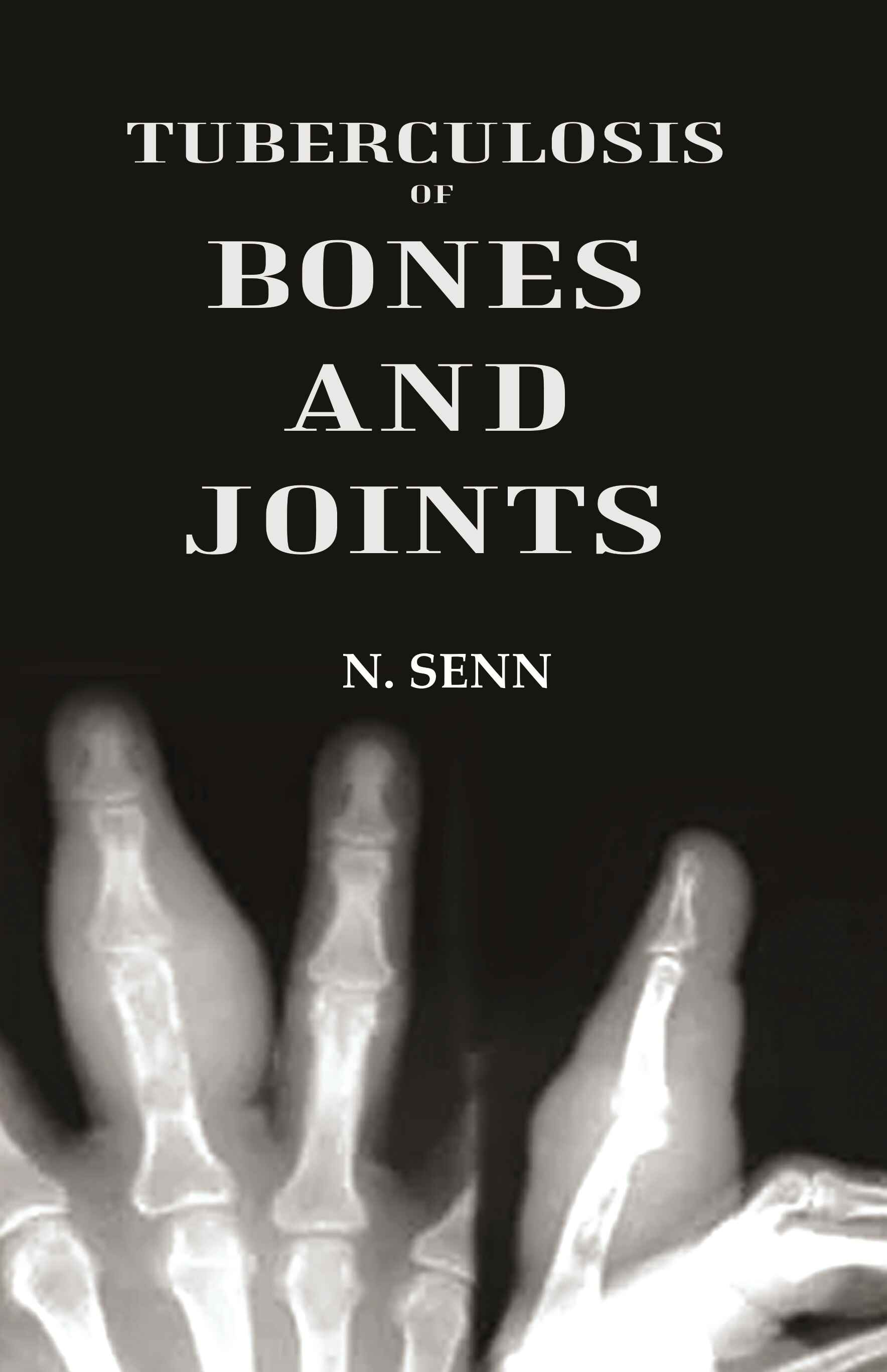 Tuberculosis of Bones and Joints - Gyan Books
