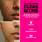 Elemen Anti-Acne Face Wash | Grab2Buy