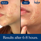Bake Acne Erase XL Pimple Patches | Grab2Buy