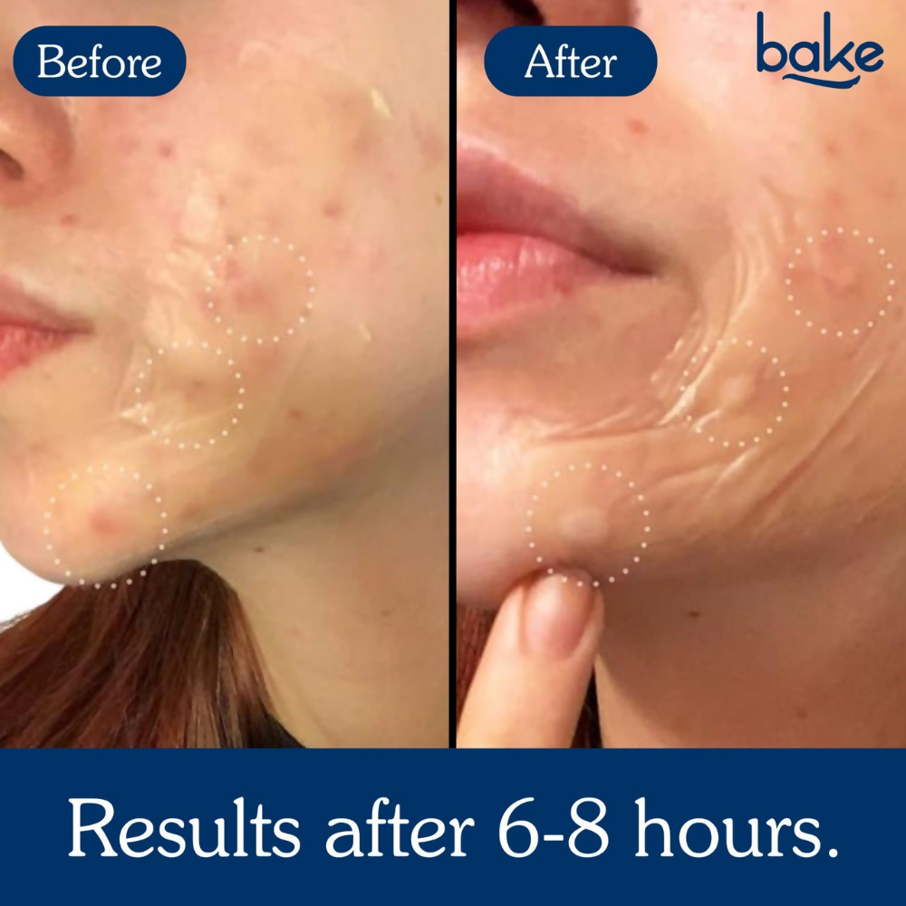 Bake Acne Erase XL Pimple Patches | Grab2Buy